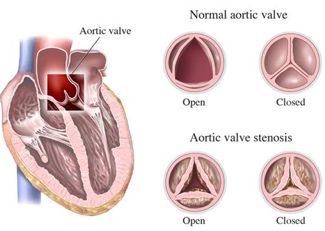 Maybe you would like to learn more about one of these? Aortic Valve Stenosis Causes Treatment in Waco,TX [How to ...