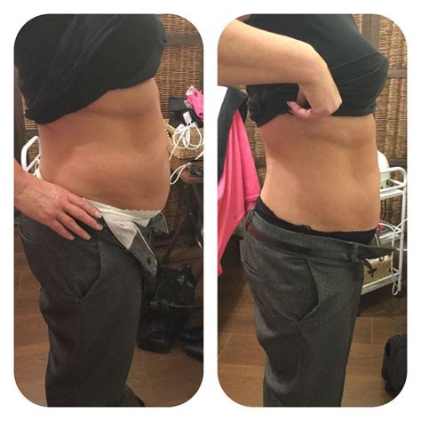 7inches Lost With Our 8 Sessions Of Laser Lipo Laser Lipo Belly