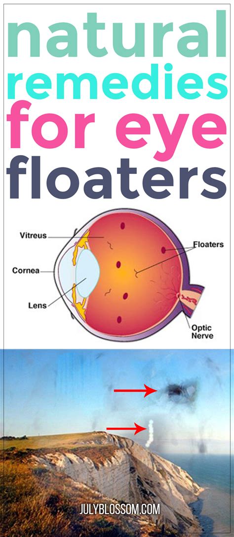Natural Remedies For Eye Floaters ♡ July Blossom