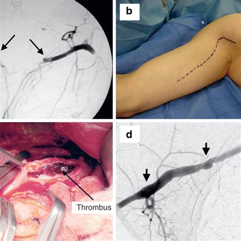 Axillary Artery Thrombosis A Intraoperative Angiogram Demonstrates
