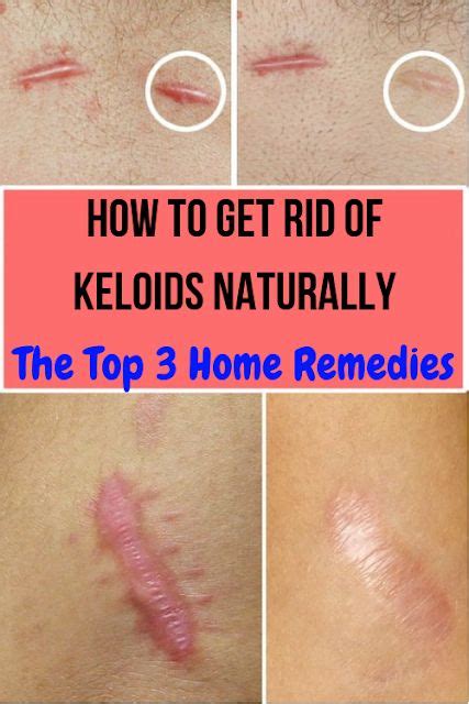 How To Get Rid Of Keloids Naturally The Top 3 Home Remedies Remedies Home Remedies Health