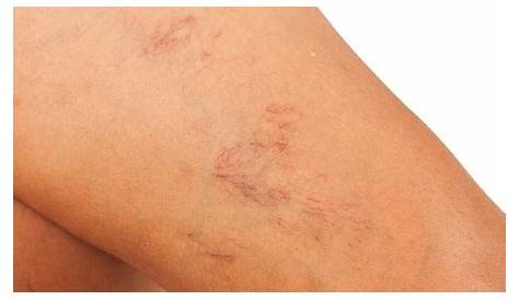 vascular skin lesions pictures