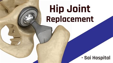Total Hip Replacement Hip Replacement Surgery Joint Replacement