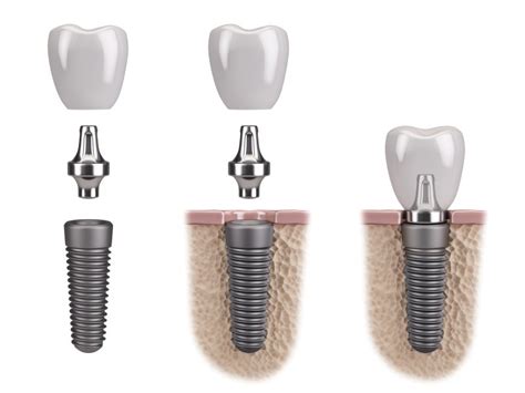 Top 5 Benefits Of Titanium Dental Implants