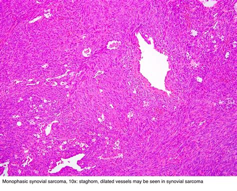 Pathology Outlines Synovial Sarcoma