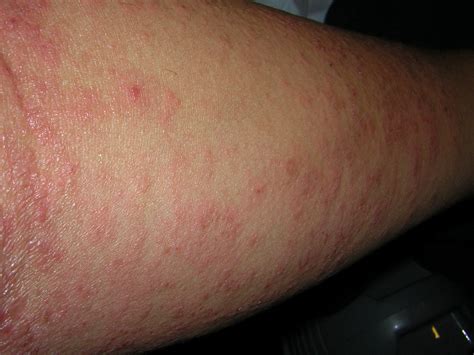 Scabies Arm Pictures Photos