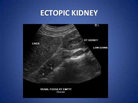 Images Of Horseshoe Kidney Ultrasound Images