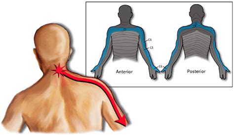 Nhwc Media Blog Understanding A Pinched Nerve In The Neck