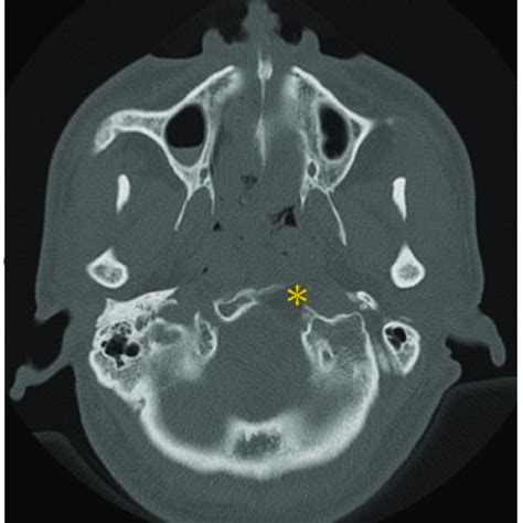 Pdf Diagnosis And Treatment Of Inflammatory Pseudotumor With Lower