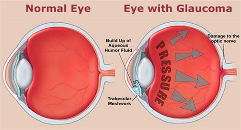 High eye pressure and headaches. Glaucoma Symptoms, Causes, & Homeopathic Treatments ...
