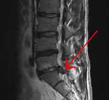 Extruded Lumbar Disc Herniation Pictures