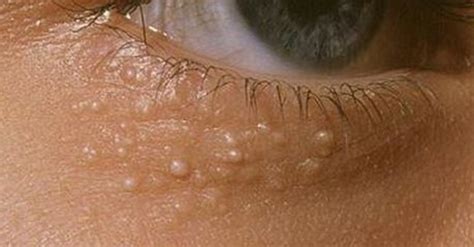 Heres Why Some People Have Those Weird White Bumps Around Their Eyes