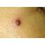 How To Check Skin Moles Detect Cancer  Detecting