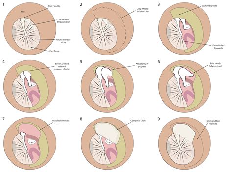 Mastoidectomy Enteducationswansea