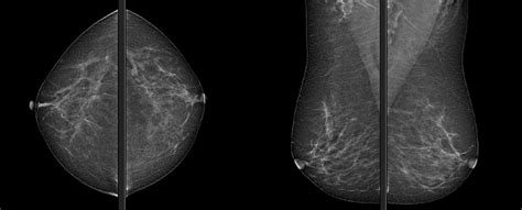 Mammography Cc And Mlo Views Download Scientific Diagram