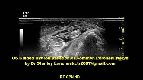 Common Peroneal Nerve Ultrasound