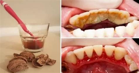 Remove The Dental Tartar Plaque And Destroy The Bacteria In Your Mouth