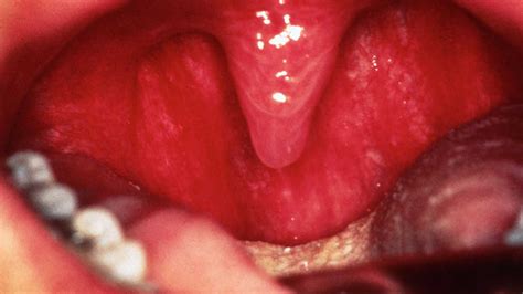 Little Red Dots On Roof Of Mouth Sore Throat Latest Rooftop Ideas