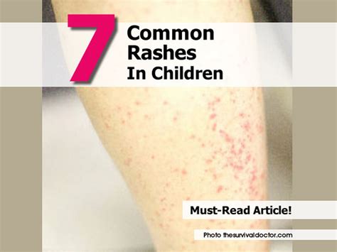 7 Common Childhood Rashes Identify And Treat Your Chi