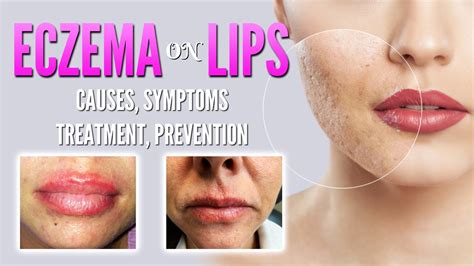 Eczema On Lips Causes Symptoms Treatment Remedies Prevention