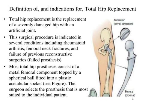 Ppt Total Hip Replacement Powerpoint Presentation Free Download Id