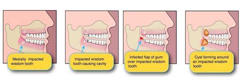 Symptoms Of Wisdom Teeth Coming In Dizziness Teeth Poster
