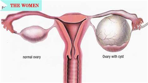 Diagnosis And Treatment Of Ruptured Ovarian Cysts General