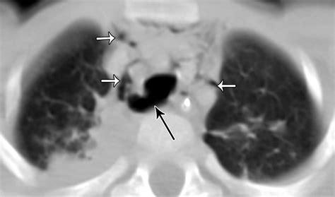 Multidetector Ct Of Blunt Thoracic Trauma Radiographics