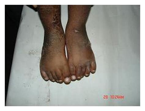 Clinical Photos Showing Correction Of Deformities Achieved By