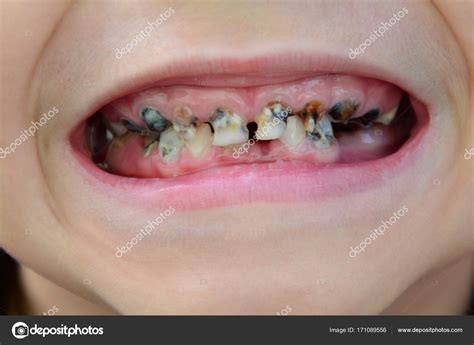 Los síntomas de la pudrición dental en el tratamiento para los dientes podridos es generalmente el mismo para niños y adultos, y salvar el diente es el objetivo del tratamiento. Los Dientes Los Niños Con Caries Enfermen Los Dientes Del ...