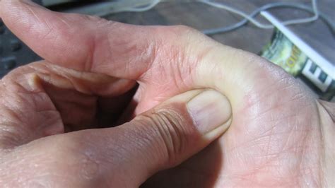 Pinched Nerve In Thumb Self Massage This Really Works Youtube
