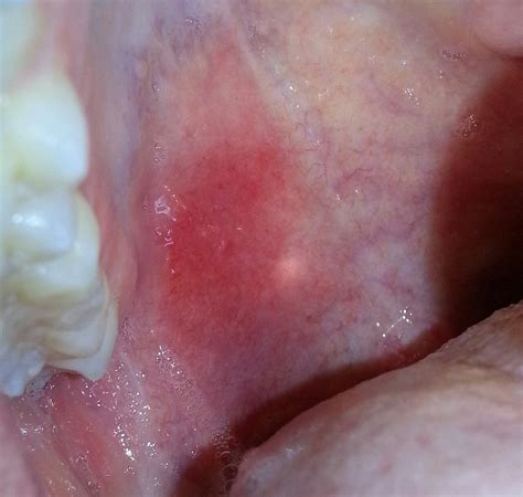 Painful Lump In My Mouth What Is It Medical