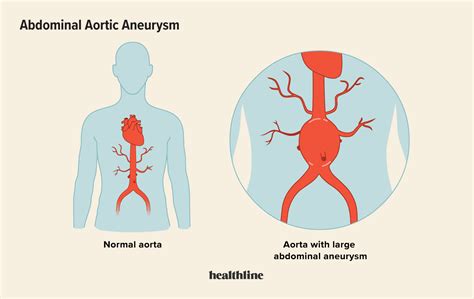 Abdominal Aortic Aneurysm Causes Treatment And Prevention
