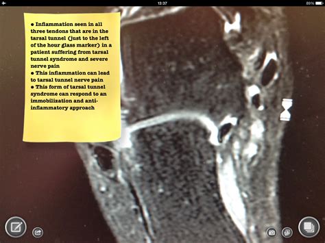 Foot And Ankle Problems By Dr Richard Blake Tarsal Tunnel Syndrome