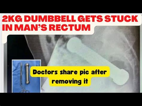 Kg Dumbbell Gets Stuck In Mans Rectum Doctors Share Pic After