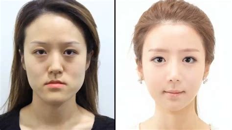 South Korea Plastic Surgery Before And After