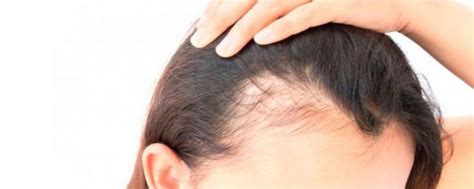 ¿padeces Alopecia Androgénica Femenina ¿sabías Que Indermis