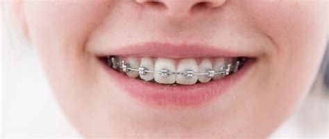 Braces And Orthodontics In Fort Worth Tx North Texas Smiles