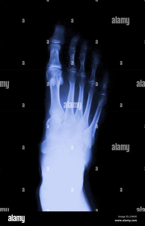 Foot Fingers On The X Ray Stock Photo Alamy