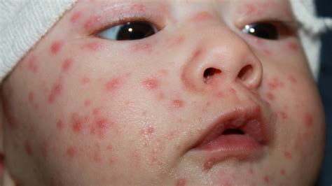 Chicken Pox Vaccine And Symptoms In Adults And Children