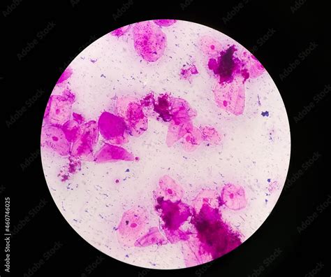 Microscopic Close View Of High Vaginal Swab Gram Stain Smear 40x