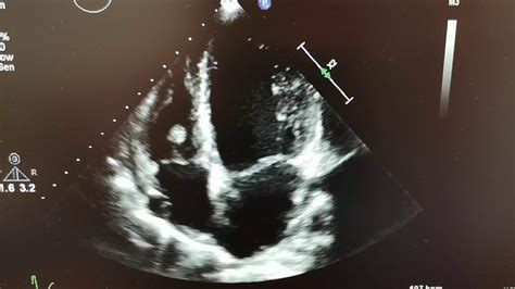 Echocardiogramechocardiography Thrombus Right Ventricle Cardiology