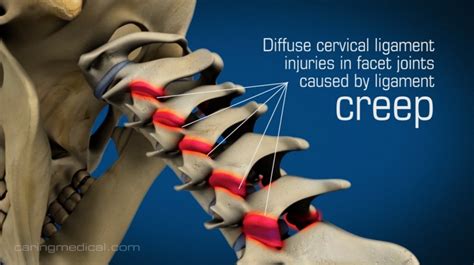 Neck Ligaments