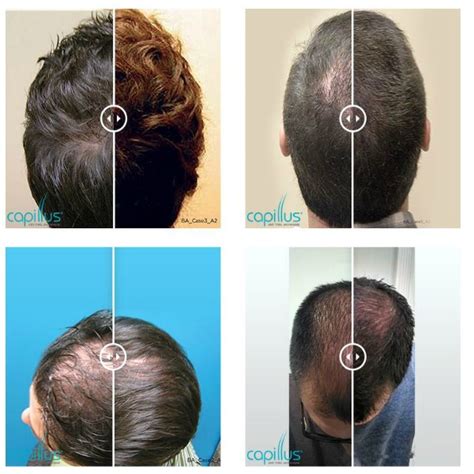 If it doesn't have a content attribute it wont show up. Men Before and After Capillus Hair Loss Treatment | Willow ...