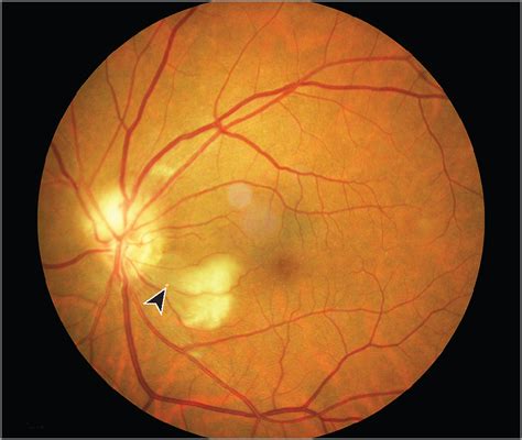 Embolic Anterior Ischemic Optic Neuropathy Associated With A