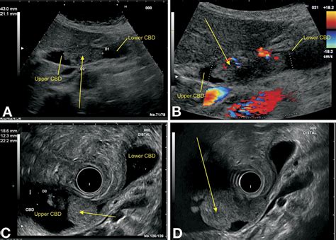 An Unusual Endoscopic Ultrasound Image Of The Common Bile Duct