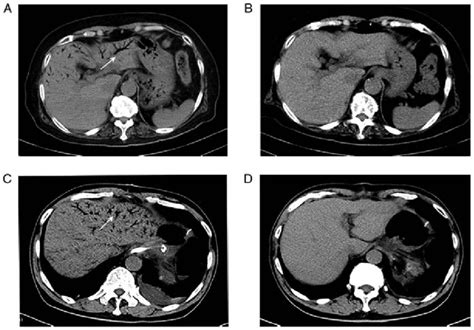 Absorption Of Venous Gas In Two Patients With Hepatic Portal Venous