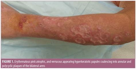 Hypertrophic Lupus