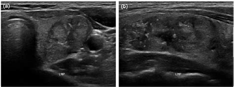 Figure 1 From The Relationship Of Thyroid Nodule Size On Malignancy