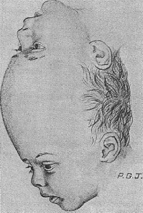 Oconnells Classification Type I Vertical Craniopagus Download